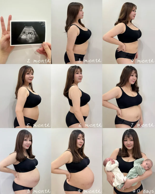 一張蓄謀已久的照片😎
好像還沒跟大家分享我生產的過程
「待產那天我直接被醫生緊急轉到待產病房🥶」

待產入院那天大概是我人生最痛苦難熬的一晚
入院那天在醫院辦理完入院手續
接著去麻醉評估…等過完關卡後
最後到了住院病房的樓層
一到櫃檯護理師就過來幫我量血壓
結果血壓衝到一個超爆高💥
護理師被嚇到花容失色😂
直問我有沒有不舒服？頭痛？視線模糊？
我：「沒有欸，我完全沒感覺，就是有點緊張」
護理師馬上告訴我的主治醫師

我爸媽雙方家族都有血壓慢性病史
爺爺沒事血壓都是180起跳
所以我平時血壓也是偏高
懷孕再加上懷雙胞胎
讓我孕期的血壓又更高
從16週就開始服用低劑量阿斯匹靈
孕晚期也開始吃較溫和孕婦可吃的降壓藥
我得非常注意自己的身體狀況
如有劇烈頭痛、腹痛、視力模糊等
必須馬上到產房報到
連急診都不用去直接衝產房
這些醫師已反覆叮嚀多次
我孕期最大的問題就是「子癲前症」
雖然我每次驗尿尿蛋白都過關
但每次血壓就是很高
不過我都沒有不舒服
我自己覺得我應該是遺傳性慢性高血壓

————————————

待產當天量完血壓後
我們到了健保病房打開行李
護理師請我先躺在床上裝上胎心儀
雙胞胎要綁兩條所以我整個被固定住動彈不得
過沒多久護理師連忙進來說
：「趙醫師說要馬上轉到待產病房喔！」

於是西蒙趕緊再把行李收拾好我們要轉樓層了
因禍得福我們離開了擁擠的三人病房（自費病房滿了）
來到了單人待產病房
打了滯留針、接上了硫化鎂點滴（降血壓）
巨肚綁上了兩條胎心儀
準備渡過卸貨前的最後一晚
原本以為自己很幸運可以好好享受單人病房

結果…那裡病房非常悶熱🥵
孕晚期的我隨時都很喘
加上嚴重鼻塞
我根本吸不到空氣

我的膀胱被嚴重擠壓
基本上半小時得起來尿尿一次
每一次起身都是一次煎熬
因為肚子太大了
加上當時已掛了點滴
身上綁著兩條胎心儀一堆電線連接著機器
所以我每一次去尿尿都要拆卸
再推著點滴去尿尿
回病房後還要通知護理師幫我把胎心儀裝回去
入夜後我超級不好意思…
我：「我可能會一直在需要麻煩你們欸…我的膀胱大概只能堅持半小時了…」
護理師很天使的說：「沒關係！妳就告訴我們就好！如果妳覺得一直起床很不舒服，也可以先插尿管，這樣妳會比較輕鬆」

我最害怕的其實就是「插尿管」🥶
但我決鼓起勇氣先插上尿管因為怕太麻煩護理師
加上當晚接生不斷她們超級忙碌（感受不到低出生率）
結果在用棉花棒消毒尿道口時
我痛到整個屁股揪起來！甚至叫了出聲😫
以至於插尿管時我根本無法放鬆
全力出力抵抗尿管侵入😂
整夜晚覺得尿道超級不舒服！
膀胱整個要爆炸💥
一直ㄍㄧㄥˉ著無法放鬆
一放鬆就感覺尿道被堵住、最後還滲尿
我大概忍了2小時覺得不對勁才請護理師查看
原來是沒插好…尿管放得不夠深
需要再重新放進去一點
我當時緊張到全身都在發抖…因為超級痛❗️
我心想我算很會忍痛了欸這個痛正常嗎？

調整尿管時我痛到屁股一抬…尿管整個跑出來了…
原本胎心儀要裝一整晚不能拆
後來雙胞胎狂動心跳一直跑掉
所以到了凌晨五點護理師說可以拿掉了
於是我決定等手術再重新插尿管好了…
真的無法在痛一次了…

到了凌晨五點我一秒鐘都無法闔眼
尿道問題結束後
一直存在的還有悶熱不流通的空氣
與嚴重的妊娠鼻塞
我只能用嘴巴呼吸
然後平均幾分鐘就會喘不過氣來😮‍💨
依然半小時要奮力起身一次尿尿
巨肚壓著我整個夜晚陷入這樣的無限輪迴…
我就這樣看著時鐘…6點…8點…

終於10點了！
我期待著護理師進來說要術前準備🥹
終於…我移到了待產區、戴上手術帽
我知道…我終於要解脫了！終於要卸貨了！
但同時我也很緊張…
不知道手術會不會順利？
不知道雙寶與自己是否會平安？
就這樣和西蒙道別👋
被推進了產房…

（待續）